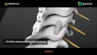 DTRAX - małoinwazyjne leczenie b&oacute;lu korzeniowego w kręgosłupie szyjnym.