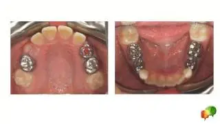 Serial Extraction Answer