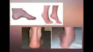 Equinus gait; walking pattern where a person primarily walks on toes, balls of their feet