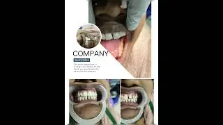 #Discoloured teeth#Rct treated #pfm crowns #Happy🙂#Postive🎉#oral health #Brush teeth daily twice 😎✌️