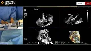 Final EVOQUE Optimisation in TTVR &ndash; Tilt Adjustment with MPR Echo and Fluoro