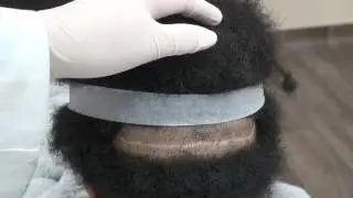 Black Female Linear Scar FUT Hair Transplant 