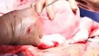 How is tubal ligation (permanent sterilisation type: Pomeroy) after cesarean delivery performed?