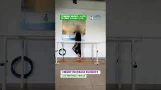 +6 CM WALKING EXERCISE / LON METHOD FEMUR #limblengtheningsurgery #heightincrease