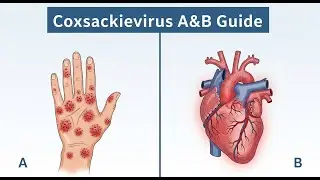 Coxsackievirus A&B [RNA, Naked, Positive Sense, Picornaviridae]