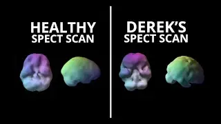 How Childhood Trauma Affects the Brain - Early Childhood Speaker from Foster Care shares brain scans