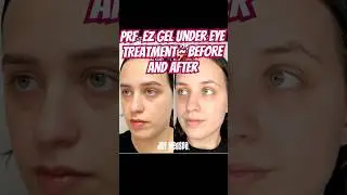 PRF EZ Gel Under Eye Treatment ~All Natural #undereyetreatment #undereyecircles #allnatural