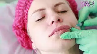 Augmentarea buzelor cu canula