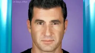 BOTOX Before and After Gallery 4