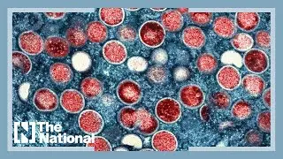 Podcast: The global monkeypox outbreak amid a pandemic