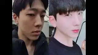 [Grand Plastic Surgery] Eyes+Rhinoplasty for Men.