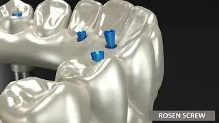 Rosen Screw