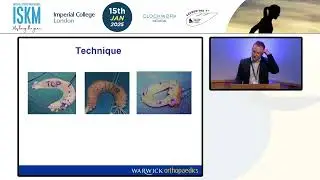 Meniscal Allograft Transplantation – Where Are We in 2025? | Nick Smith