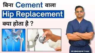 What is cementless hip replacement? | Cementless hip replacement surgery (THR)