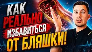 РЕАЛЬНЫЕ способы ИЗБАВИТЬСЯ от бляшки в сосуде!  Чистка сосудов. Операции при атеросклерозе. 