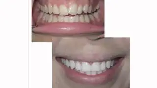 How Invisalign Works