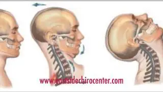 Eastside Chiropractic Center - Whiplash Overview