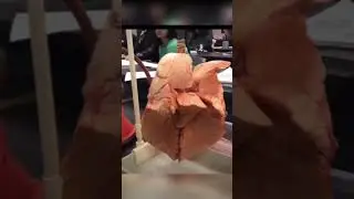 Normal lung as compared to smokers lungs