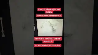 Rasooli ka jadeed elaj angiography se #shortsvideo #doctor #uterineembolization #hospital