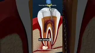 Proses Perawatan Saluran Akar gigi #PSA