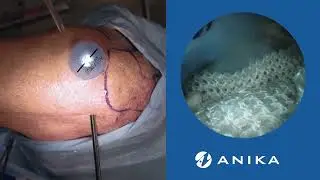Integrity Partial Thickness Rotator Cuff Repair