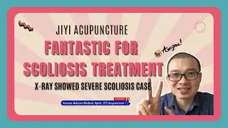 X-ray showed severe scoliosis case-Jiyi Acupuncture is fantastic for Scoliosis treatment