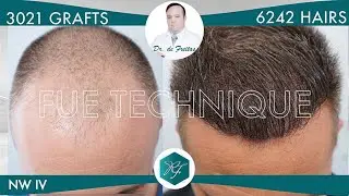 Hair Graft Technique FUE Grafts 3021 (6242 Hairs)