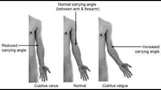 Cubitus varus And valgus; deformities of the elbow that affect the carrying angle of the arm