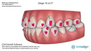 Treatment of highly placed canine with Invisalign aligners in India