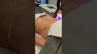 Waves 21 deel Cryotherapie