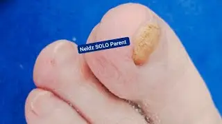 Mike's Toenail Pedicure #saisfying Neldz SOLO Parent  is live!