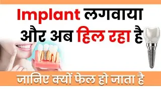 Dental Implant Loose Ho Raha Hai?| Why Implants Fail & Fast Fix Solutions
