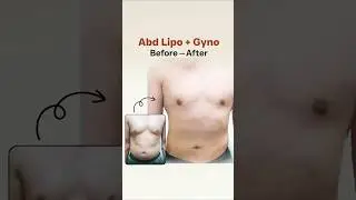 Gynecomastia + Abdominal Liposuction Transformation | Complete Male Body Contouring