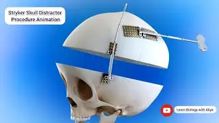 🧠 Stryker Skull Distractor Procedure Animation | Medical 3D Animation