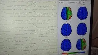 Bosh miyaning EEG tekshiruvi Xazorasp