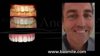 Alignement simple : S1 Haut  : B And Smile one Haut S1 haut selon l'orthodontie du sourire