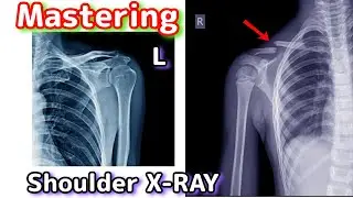 Mastering Shoulder X-Ray: A Guide for Medical Students