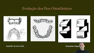 Aula Fios Ortodônticos: parte I - Prof Glauber