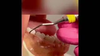 Area Specific Curette - Gracey 7/8. Demonstration on posterior teeth (31 & 30).