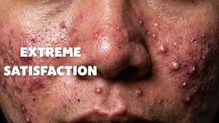 SAC DEP SPA OFFICIAL | Extreme Acne Care