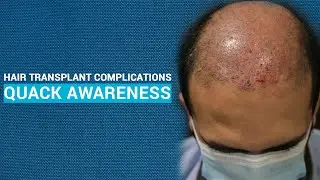 Quack Awareness and Hair Transplant Issues | Hair Transplant Complications | Jj Aesthetics.