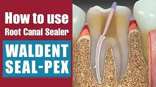 How to use Root Canal Sealer | Waldent Seal-Pex