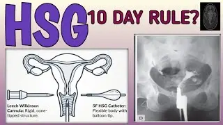 Mastering HSG ! HYSTEROSALPINGOGRAPHY explained!