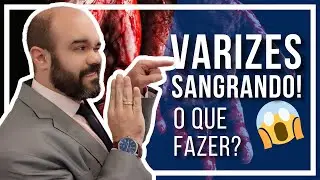 🔴 VARIZES SANGRANDO!! O que você deve fazer para evitar o pior? [OBRIGATÓRIO PARA QUEM TEM VARIZES]