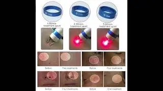 1470nm endolift diode laser machine