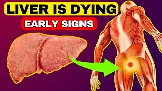 Liver Is Dying! 6 Weird Signs That You Have Liver Damage