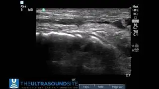 Tibialis Anterior Rupture II