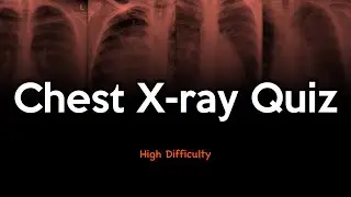 Chest X-ray Quiz: High Difficulty