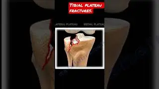 Tibial plateau fractures #shorts
