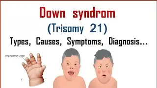 Down syndrome | Trisomy 21 | Causes, Symptoms, Types, Diagnosis